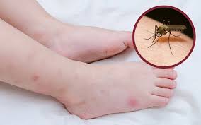 Cảnh Báo Mùa Muỗi Những Ngày Đầu Hè
